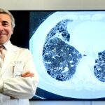 Il Policlinico Gemelli all’avanguardia contro la fibrosi polmonare idiopatica